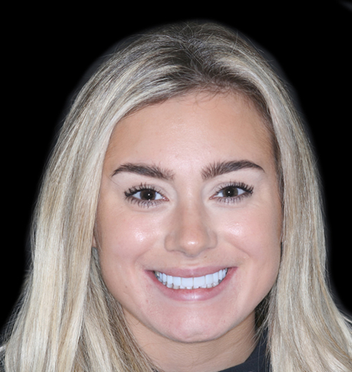 Composite Bonding Gallery Bolton Dental Design Studio