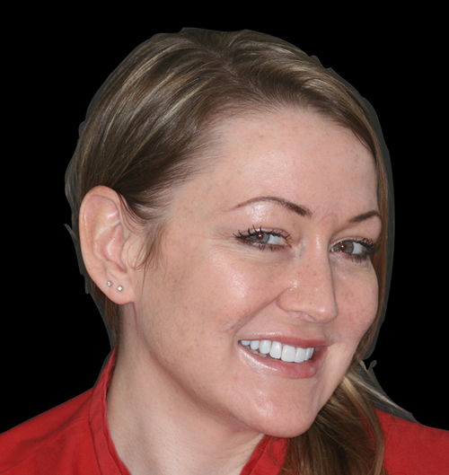 Composite Bonding Gallery Bolton Dental Design Studio